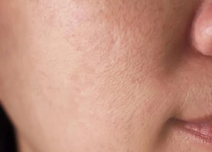 Cheek and nose area after use, tone noticeably more even