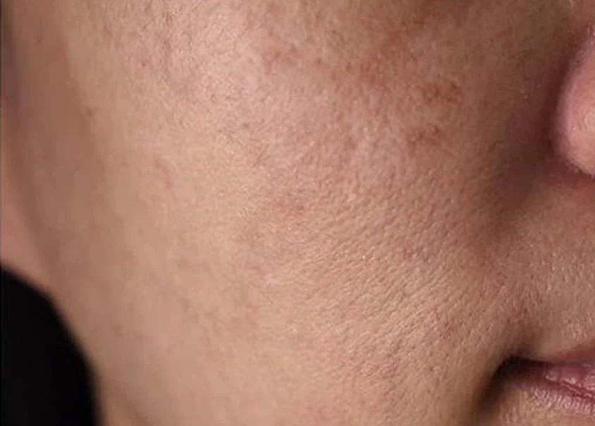 Cheek and nose area before use, with visible dark spots