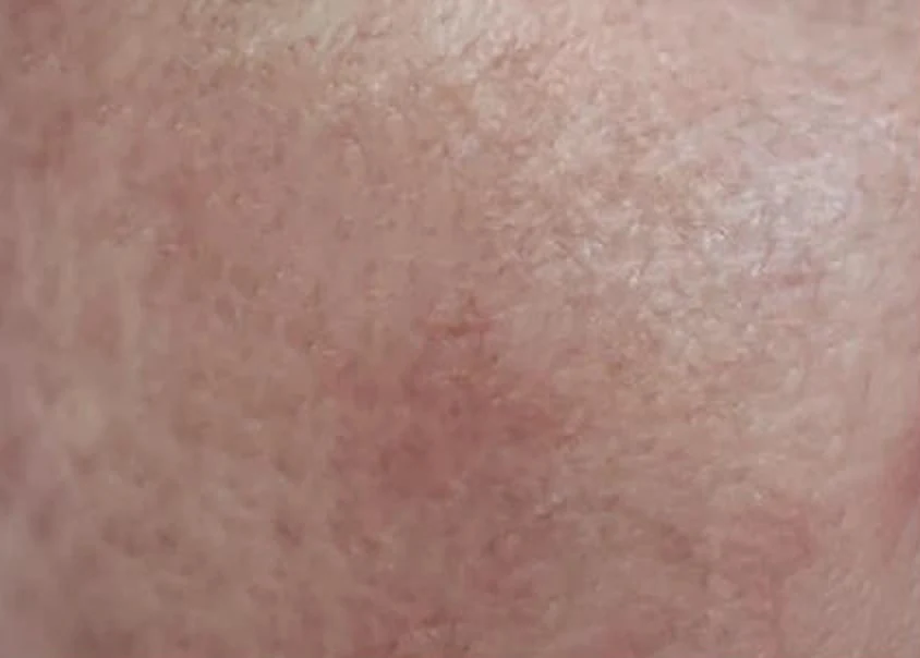 Cheek after use, patchy pigment visibly softened