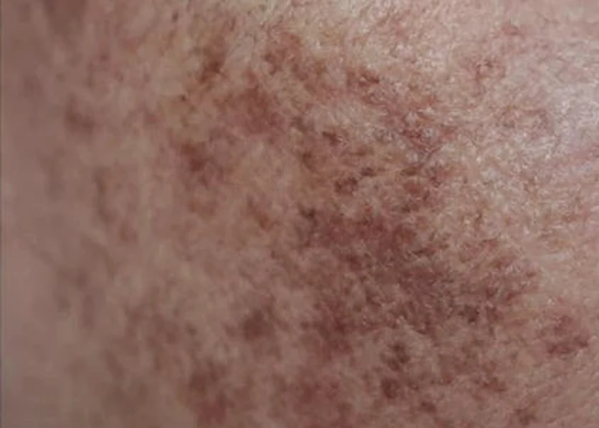 Cheek before use, with a dense patch of pigment